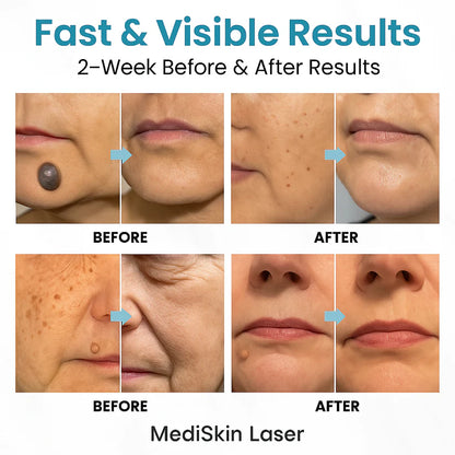 MediSkin Laser